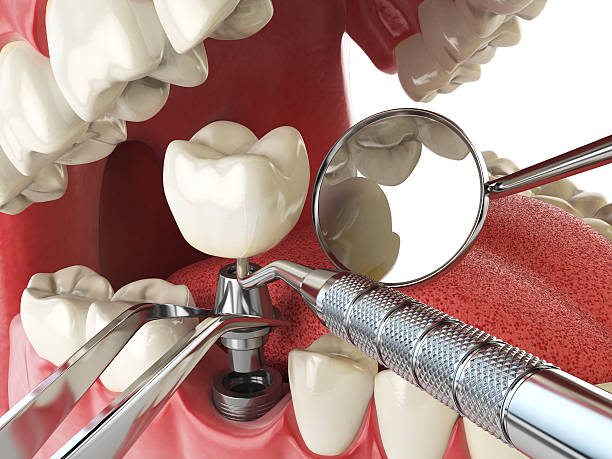 Best Emergency Denture Repair in North Auburn, CA